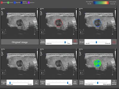 A Computer-Aided Diagnosis System and Thyroid Imaging Reporting and Data System for Dual Validation of Ultrasound-Guided Fine-Needle Aspiration of Indeterminate Thyroid Nodules